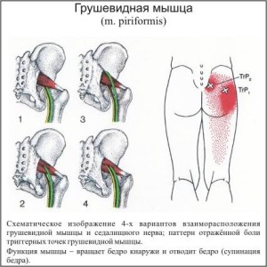 Sindrom grushevidnoi mishci