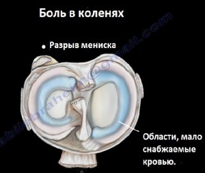 Областимениска, плохо снабжаемые кровью